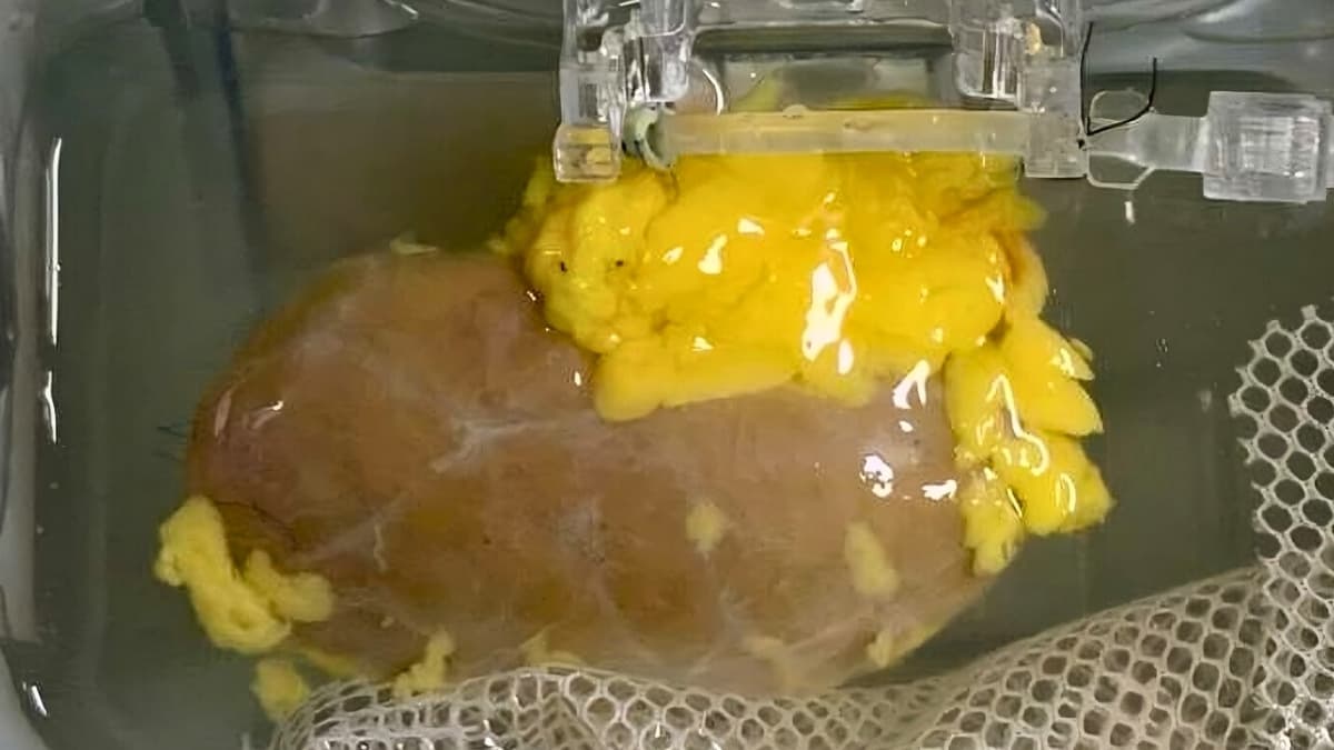 The 'Universal Kidney' Lie: Who Really Profits When Blood Barriers Crumble?